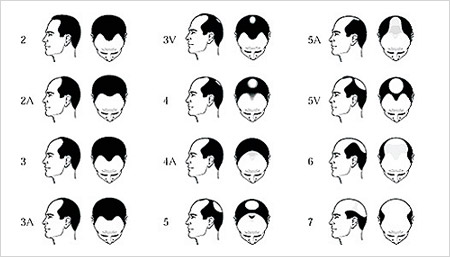 Stages of Male Pattern Baldness