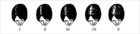 Stages of Female Pattern Baldness